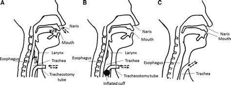 total laryngectomy vula|laryngeal tube vs trach.
